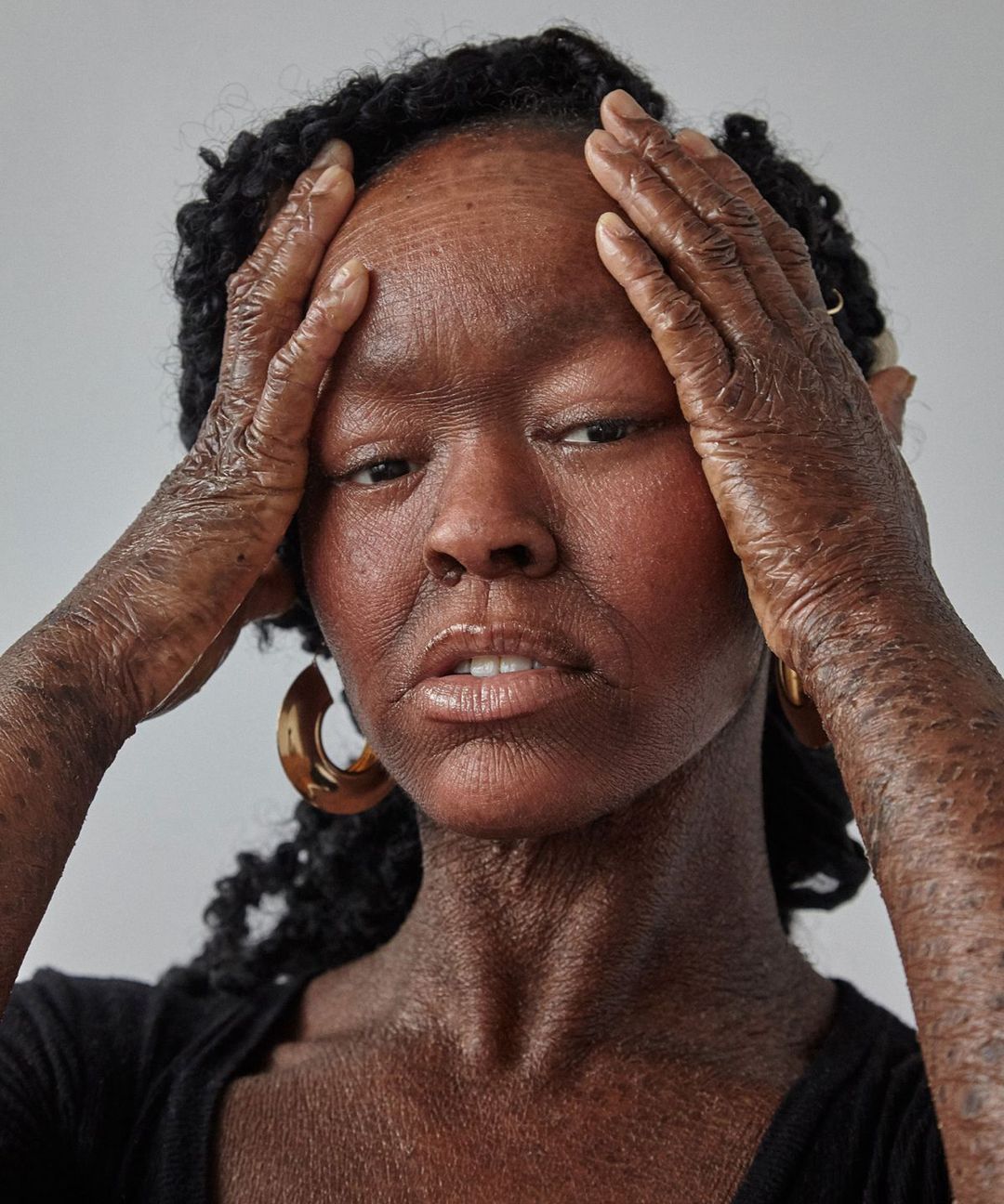 This Model With A Rare Skin Condition Shows How Different Is Beautiful Doyou Doyou 